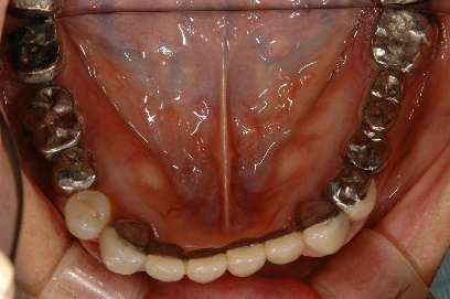 インプラント臼歯 下