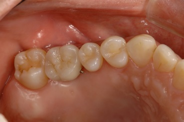インプラント臼歯3