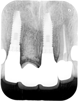 インプラント前歯症例３