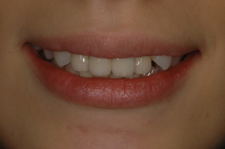 オールセラミッククラウン症例3（複数歯）